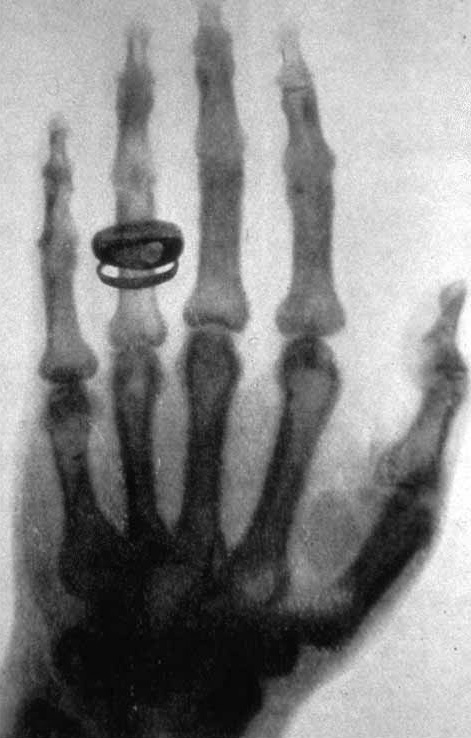 Сделанная В. К. Рентгеном фотография (рентгенограмма) руки Альберта фон Кёлликера